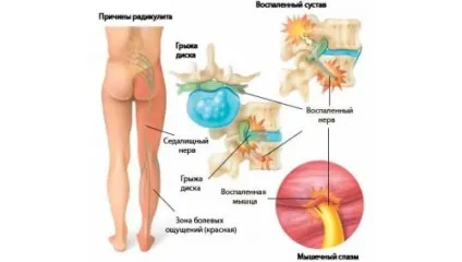 Гострий радикуліт симптоми і перша допомога (гострий) Гострий радикуліт симптоми і перша допомога