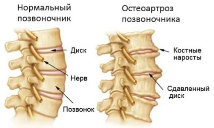 Остеоартроз хребта і його симптоми (руйнування хрящової тканини) Остеоартроз хребта і його симптоми