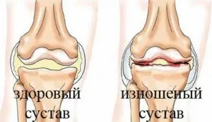 Від чого буває артроз причини виникнення та види хвороби (причини) Від чого буває артроз причини виникнення та види хвороби