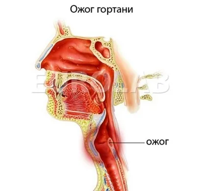Опік гортані лікування і симптоми (слизової оболонки горла) Опік гортані лікування і симптоми