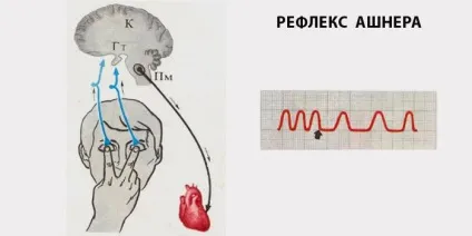 Пароксизмальна надшлуночкова тахікардія ознаки, причини і лікування (ознаки) Пароксизмальна надшлуночкова тахікардія ознаки, причини і лікування