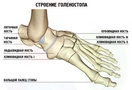 Перелом щиколотки скільки ходити в гіпсі і як лікуватися (перелом) Перелом щиколотки скільки ходити в гіпсі і як лікуватися