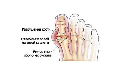 Перші ознаки подагри як визначити підступну хворобу (перші) Перші ознаки подагри як визначити підступну хворобу