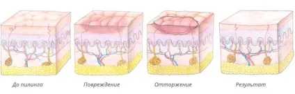 Пілінг - нова шкіра