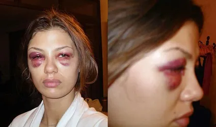 Пластика вікторії бони