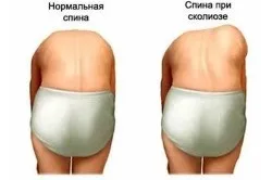 Плавання при сколіозі