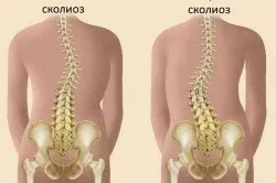 Плавання при сколіозі