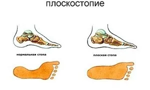 Плоскостопість - лікування у дорослих в домашніх умовах (умовах) Плоскостопість - лікування у дорослих в домашніх умовах