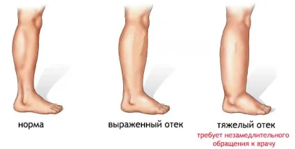 Чому з'являються набряки і як від них швидко позбутися (чому) Чому з'являються набряки і як від них швидко позбутися