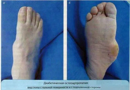 Чому болить п'ята, опухла і німіє нога в суглобах п'яти (болить) Чому болить п'ята, опухла і німіє нога в суглобах п'яти
