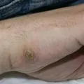 Підошовні бородавки лікування, видалення, фото, як позбутися (позбутися) Підошовні бородавки лікування, видалення, фото, як позбутися