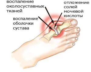 Подагра у чоловіків і жінок причини, симптоми і лікування хвороби (симптоми подагри у жінок) Подагра у чоловіків і жінок причини, симптоми і лікування хвороби