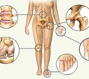 Подагра у чоловіків і жінок причини, симптоми і лікування хвороби (подагра ознаки) Подагра у чоловіків і жінок причини, симптоми і лікування хвороби