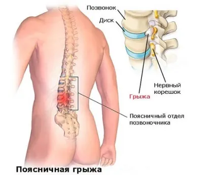 Чи корисно висіти на турніку при грижі поперекового відділу хребта і підтягуватися (турніку) Чи корисно висіти на турніку при грижі поперекового відділу хребта і підтягуватися