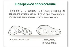 Плоскостопість 1 ступеня у дорослих лікування (плоскостопість) Плоскостопість 1 ступеня у дорослих лікування