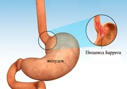 Стравохід Барретта що це, причини виникнення хвороби (хвороби) Стравохід Барретта що це, причини виникнення хвороби