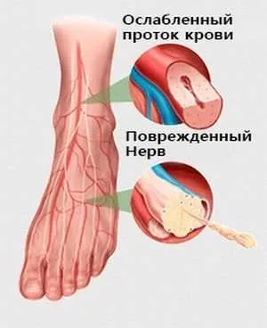 Периферична нейропатія як виявляється і лікується хвороба (волокно поступово відновлює) Периферична нейропатія як виявляється і лікується хвороба