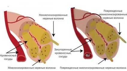 Периферична нейропатія як виявляється і лікується хвороба (периферична нейропатія симптоми лікування лікар біль фізіотерапія ураження нервових волокон магнітно-резонансна томографія) Периферична нейропатія як виявляється і лікується хвороба