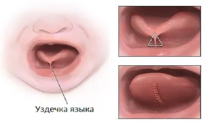 Пластика вуздечки язика у дітей - підрізання вуздечки язика лазером, ціни, відео (пластика вуздечки язика) Пластика вуздечки язика у дітей - підрізання вуздечки язика лазером, ціни, відео