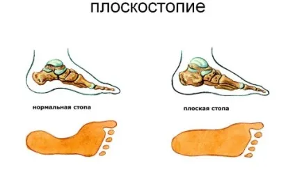 Плоскостопість 1 ступеня у дорослих лікування (плоскостопість) Плоскостопість 1 ступеня у дорослих лікування