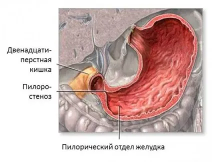 Пилорический відділ шлунка де знаходиться, будова, гістологія (знаходиться) Пилорический відділ шлунка де знаходиться, будова, гістологія