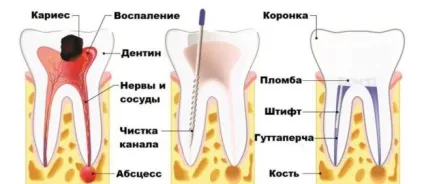 Після видалення нерва болить зуб причини і способи лікування (болить) Після видалення нерва болить зуб причини і способи лікування