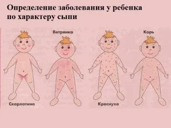 Причини, чому у дитини висип і температура
