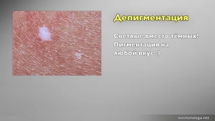 Причини появи пігментних плям - як перемогти пігментацію (причини) Причини появи пігментних плям - як перемогти пігментацію