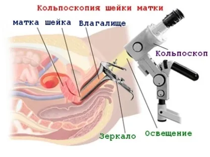 Причини і наслідки загину матки