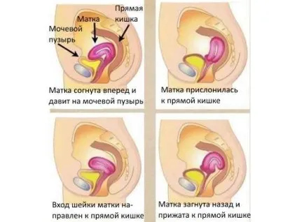 Причини і наслідки загину матки