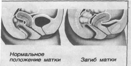 Причини загину матки