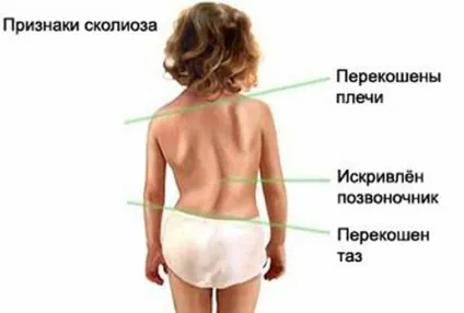 Причини сколіозу хребта - як визначити і чим небезпечний сколіоз (ортопедія і травматологія) Причини сколіозу хребта - як визначити і чим небезпечний сколіоз