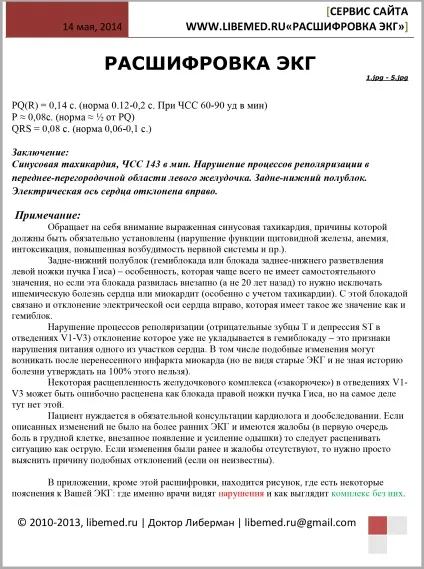 Приклад розшифровки ЕКГ (міокарда лівого шлуночка) Приклад розшифровки ЕКГ