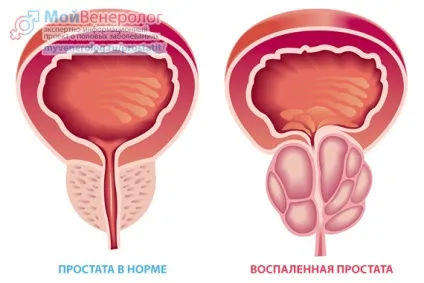 Простатит симптоми, ознаки та види, діагностика і лікування простатиту у чоловіків (простатит) Простатит симптоми, ознаки та види, діагностика і лікування простатиту у чоловіків