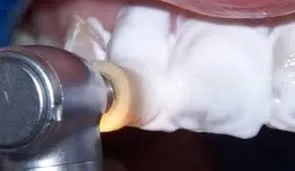 прямі вініри