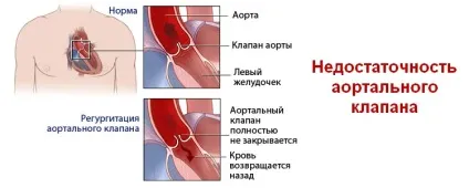 Прояви, діагностика та тактика лікування аортального пороку серця (лікування) Прояви, діагностика та тактика лікування аортального пороку серця