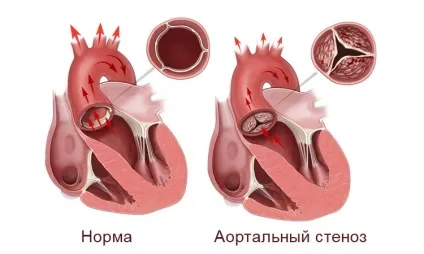 Прояви, діагностика та тактика лікування аортального пороку серця (прояви) Прояви, діагностика та тактика лікування аортального пороку серця