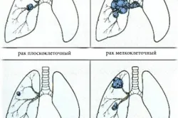 Резекція легені післяопераційний період і реабілітація (пульмонолог будинку) Резекція легені післяопераційний період і реабілітація