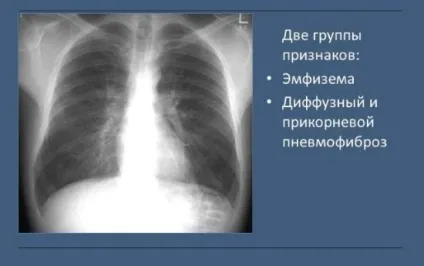 Рентген легенів при бронхіті як виглядає на рентгенівському знімку (легких) Рентген легенів при бронхіті як виглядає на рентгенівському знімку
