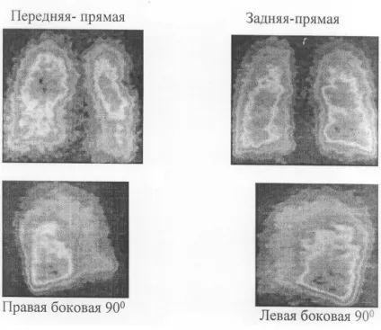 Рентген легенів при бронхіті як виглядає на рентгенівському знімку (легких) Рентген легенів при бронхіті як виглядає на рентгенівському знімку