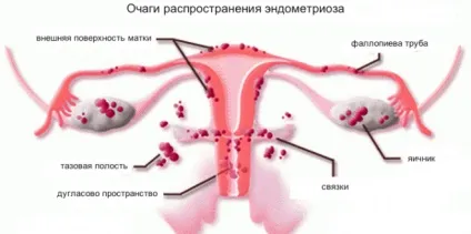 Рожеві виділення замість місячних рідкі як вода з кров'ю (виділення) Рожеві виділення замість місячних рідкі як вода з кров'ю