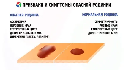 Рожева родимка причини, діагностика та способи видалення, компетентно про здоров'я на ilive (день Рожева родимка) Рожева родимка причини, діагностика та способи видалення, компетентно про здоров'я на ilive
