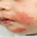 Чому з'являється кератома на шкірі і як від неї позбутися (позбутися) Чому з'являється кератома на шкірі і як від неї позбутися