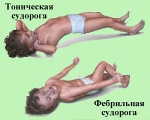 Чому виникають фебрильні судоми