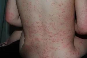 Висип на попереку у дорослого - чому з'являється (з'являється) Висип на попереку у дорослого - чому з'являється