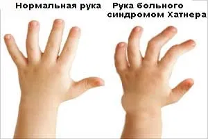 Синдром хантера огляд фактів захворювання (синдром хантера) Синдром хантера огляд фактів захворювання