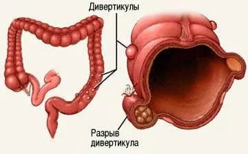 Симптоми дивертикулеза стравоходу і лікування народними засобами, фото (лікування) Симптоми дивертикулеза стравоходу і лікування народними засобами, фото