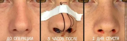 Скільки коштує вирівняти носову перегородку - відповіді і питання (через) Скільки коштує вирівняти носову перегородку - відповіді і питання