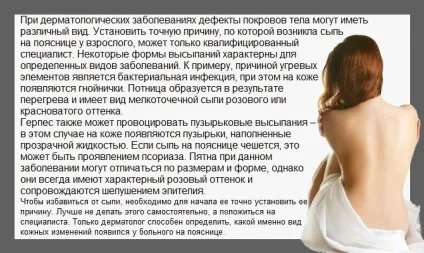Висип на попереку