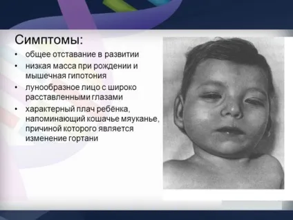 Синдром м'язової гіпотонії у дітей і новонароджених - що це таке, причини, симптоми, лікування, у (новонароджених) Синдром м'язової гіпотонії у дітей і новонароджених - що це таке, причини, симптоми, лікування, у